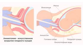 Что считается сложными родами для выплат в Salamander